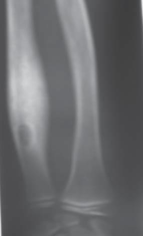 86 E. KLUCZEWSKA, E. KULETA-BOSAK, J. MACHNIK-BRONCEL, D. SOJKA, W. ROGALA, W. MADZIARA MRI serves in exact visualization of myelitis and inflammation of the soft tissues [6].