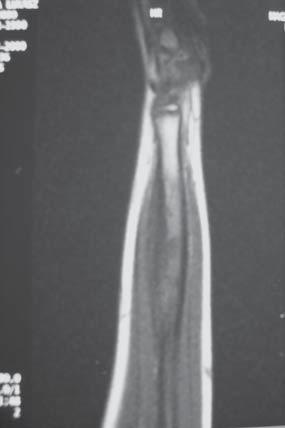 The intensity id even higher after intravenous application of a contrast agent, especially in T1-dependend presentation.