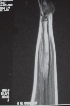 Histological examination of a specimen is necessary for exclusion of a neoplasmatic process [8]. CT gives detailed scans of bone lesions.