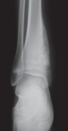 Suitability of imaging techniques in the diagnostics of ostitis in children own experiences 87 CONCLUSION Early and correct diagnosis of osteomyelitis enables effective treatment and gives a chance