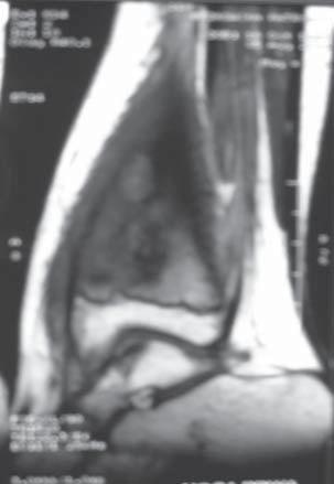 Clinical symptoms of inflammation are the most important information in early diagnostics. However a disproportion between clinical status and radiological lesions is quite common.