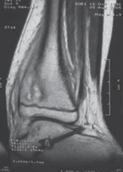 In the doubtful cases the examination of highest potential in imaging of the lesions and extension of the process in bones, soft tissues and bone marrow is MRI [13,14].