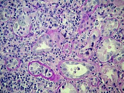 zaburzenia ukrwienia nerki przeszczepionej w badaniu USG Doppler. Z uwagi na powyższe, w 12. dniu po przeszczepieniu wykonano biopsję diagnostyczną nerki przeszczepionej.