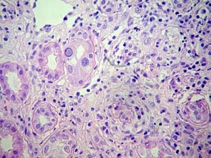 Rycina 4. Biopsja w 301. dniu po przeszczepieniu. Utrzymujące się zmiany o charakterze PVAN w fazie B2 Rycina 5.