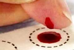 Metoda LC-MS czułość dająca nowe możliwości wykorzystania materiału badanego Sucha kropla krwi na bibule (Dried Blood Spot - DBS) Krew włośniczkowa z nakłucia opuszki palca, płatka ucha lub piętki