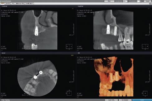 Rozdzielczość endodontyczna umożliwia bardzo precyzyjne obrazowanie struktur kanału i przyzębia