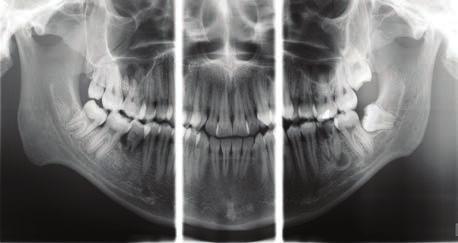 Program Ortho Zone zapewnia specjalną geometrię z szeroką warstwą przednią dla pacjentów z ekstremalnymi wadami zgryzu.