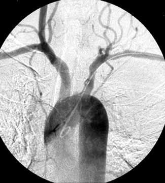 In 17 cases, vascular access was achieved through the femoral artery, in 2 cases through the common carotid artery on the side of the stenosis, and in 1 case through the brachial artery (Figures 1