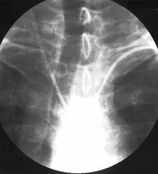 The diameters of extracranial arteries, the degree of stent dilatation, and blood flow through cerebral blood vessels A B Figure 1AB. DSA i.a. Patient with Leriche s syndrome.