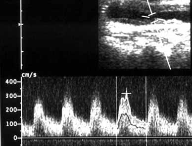 Endovascular treatment of the cervical arteries recurrent stenosis, Juszkat et al. A B Figure 3AB. USG and Doppler. A. CCA stenosis below the implanted stent. B. Spectral image record of the CCA Rycina 3AB.