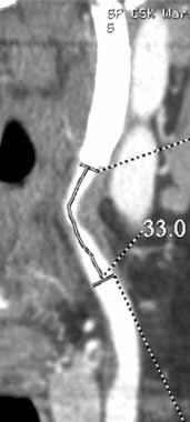 In 18 (90%) cases, the stent supported the carotid artery bifurcation as well as the proximal segment of the internal carotid artery (Table 1).