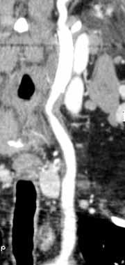 Angioplasty was performed urgently due to clinical symptoms of cerebral ischaemia which were revealed during coronography.