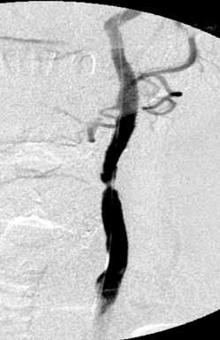 Acta Angiol., 2008, Vol. 14, No. 3 A B C Figure 5. The same patient as presented in Figure 3. DSA i.a. A. CCA stenosis below the implanted stent. BC.