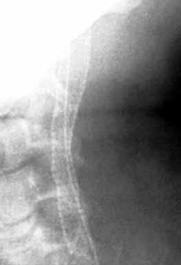 Angioplastyka i wszczepienie kolejnego stentu Intravascular procedures were repeated in all 3 patients. Angioplasty with implantation of an additional stent was performed in the first 2.