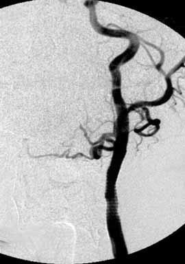 In the third patient, the midsection of the existing stent was dilatated, resulting in full patency of the artery. The patients are currently under clinical and ultrasound observation.