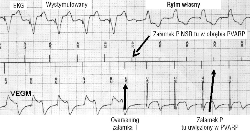 Folia Cardiologica Excerpta 2, tom 1, nr Do czynników, które mogą przerwać synchronizację, należą: przedwczesne zespoły komorowe, przedwczesne zespoły przedsionkowe, oversensing załamka T, wyczuwanie