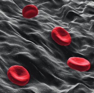 II CZĘŚĆ: HEMATOLOGIA OSTRE BIAŁACZKI SZPIKOWE I LIMFOBLASTYCZNE Ostre białaczki szpikowe i limfoblastyczne są heterogenną grupą chorób, które nieleczone w ciągu kilku tygodni prowadzą do śmierci.