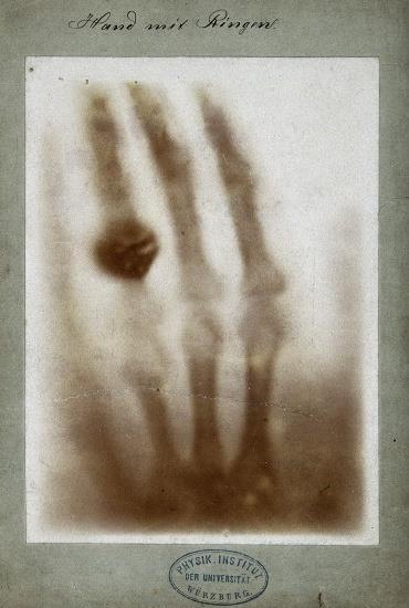 Klisze RTG Zdjęcie dłoni żony Röntgena, wykonane przez niego samego