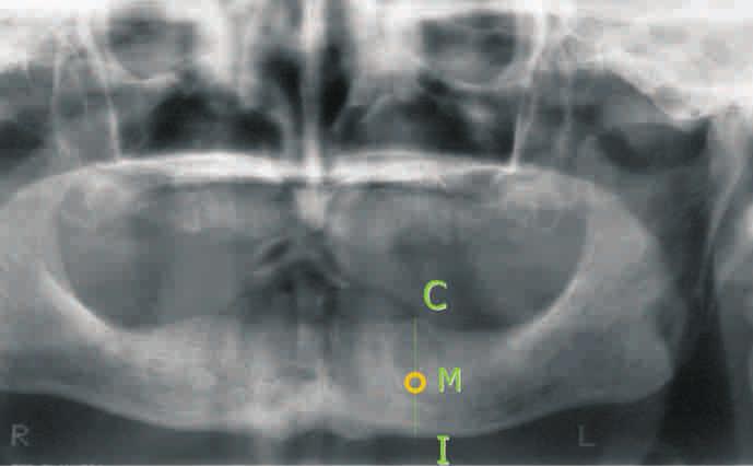 2007, tom VIII, nr 3 (28) Implantoprotetyka Ryc.1. Metoda pomiaru stopnia zaniku wyrostka zębodołowego w żuchwie wg. Wical i Swoope w modyfikacji Ortmana i wsp. Pomiar w mm.