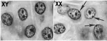 Inaktywacja chromosomu X: wyciszanie epigenetyczne XIST ncrna uruchamia zmiany epigenetyczne, które zapewniają pamięć komórkową ową stanu