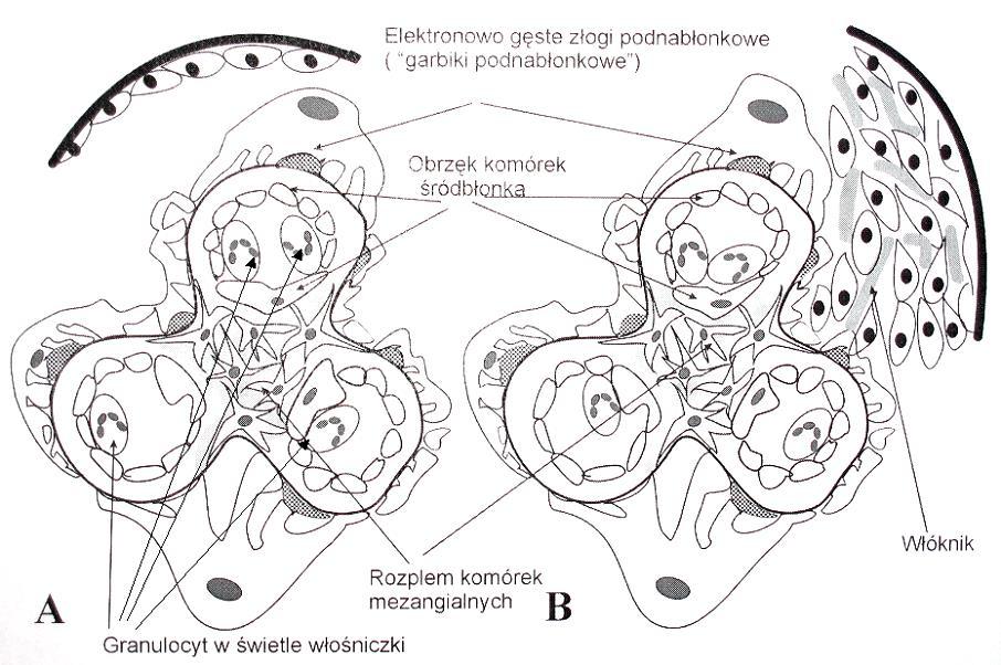Ostre wewnątrzwłośniczkowe KZN Elektronowo gęste złogi podnabłonkowe ( garbiki podnabłonkowe ) Obrzęk komórek śródbłonka Rozplem komórek mezangialnych Granulocyty w
