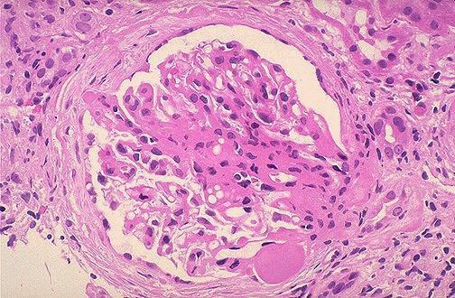 FSGS