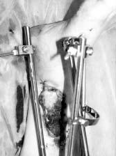 The skin defect with exposed the tibial bone A 55 year-old male sustained an open fracture of the distal part of the tibia and fibula (Gustilo IIIb) with loss of soft tissue.