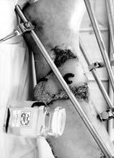 Tomasz Kulesza et al. Sural flap Polish Surgery 2008, 10, 1 Rycina 3. Zastosowanie pijawek lekarskich na zastoinowym płacie łydkowym Figure 3.