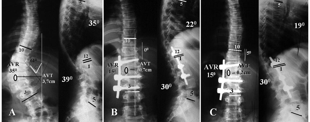 tio np roh ibit ed. Tab. 2. Radiologiczne parametry skrzywienia po leczeniu operacyjnym Tab. 2. Postoperative radiological parameters of scoliosis ibu dis tr se lu rso na pe for y is op is c Th Ryc.