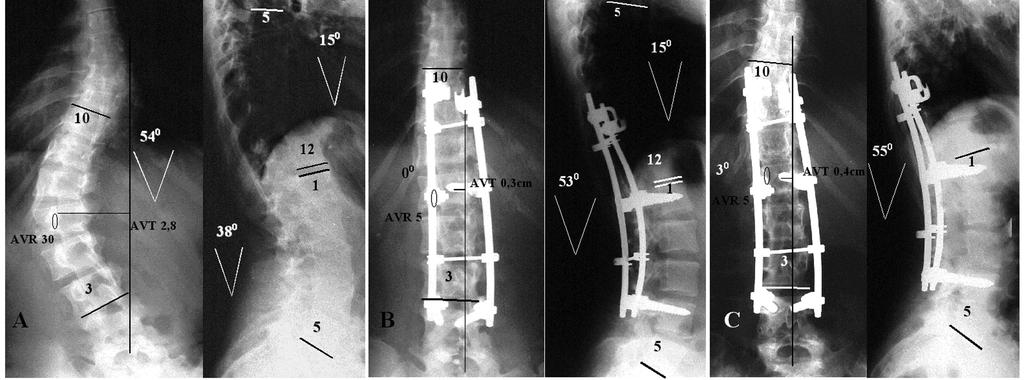 dis tr ibu Ryc. 3. Spondylodeza tylna. Rentgenogramy w projekcjach AP i bocznej: A przedoperacyjne, B pooperacyjne, C po okresie obserwacji. Fig. 3. Posterior fusion. AP and lateral xrays.