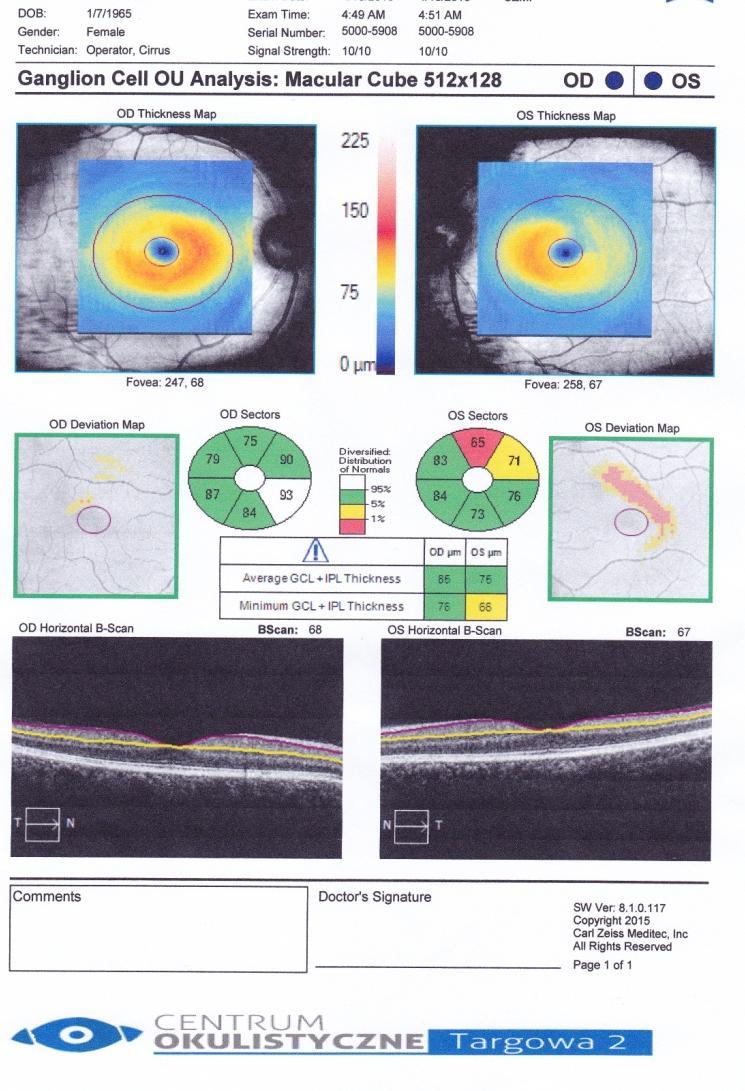 ANALIZA KOMÓREK ZWOJOWYCH GANGLION CELL ANALYSIS Określa grubość warstwy komórek zwojowych (GCL) oraz wewnętrznej warstwy splotowatej (IPL) Kolorowe mapy grubości wskazują pomiary grubości GCL + IPL