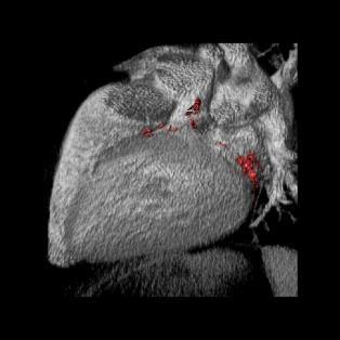 STENOZA MITRALNA DIAGNOSTYKA