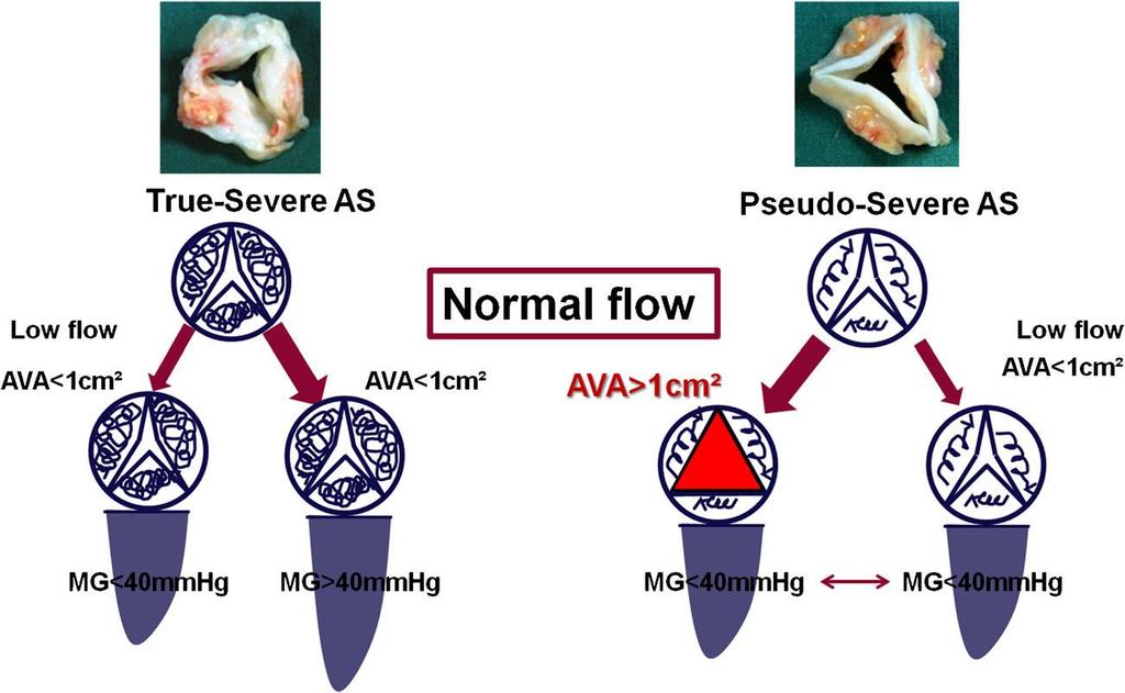 ECHOCARDIOGRAPHY (JM GARDIN, SECTION EDITOR) Evaluation of Aortic Stenosis: an Update I ncluding L ow-flow States, Myocardial Mechanics, and Stress Testing Luc A.