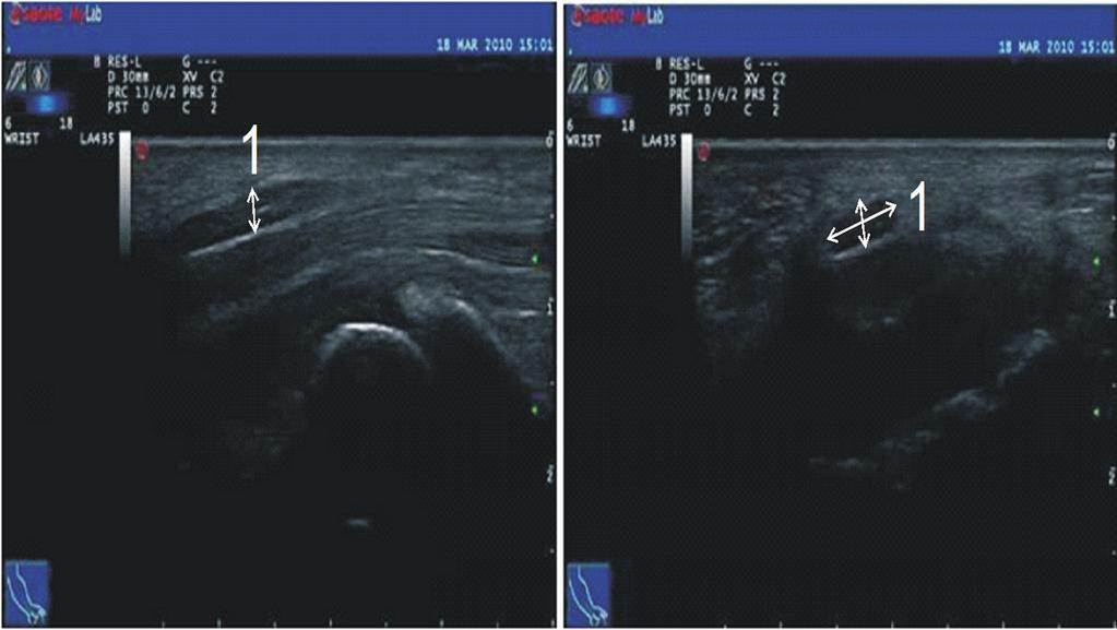 Figure 2. The early stage of the carpal tunnel syndrome with the involvement of the medial nerve before it s entrance into the tunnel at pisiform bone level. Left photo: a longitudinal section.