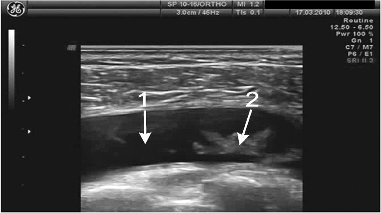 the bursae, produces inflammatory fluid. The aforementioned changes result in the pain and limitation of the movements.