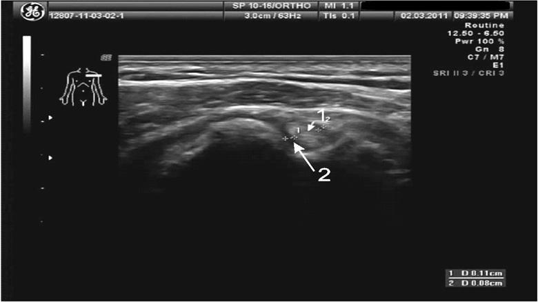 comes from the canal wall to the tendon supporting the tendon with blood vessels and nerves.