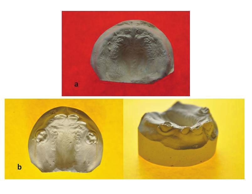 - - - - - Orthodontic problems in patients with Down syndrome from infancy... J Stoma 2015; 68, 6 Fig. 1. e s a e o t e a ate in a in ancy, todd erness.