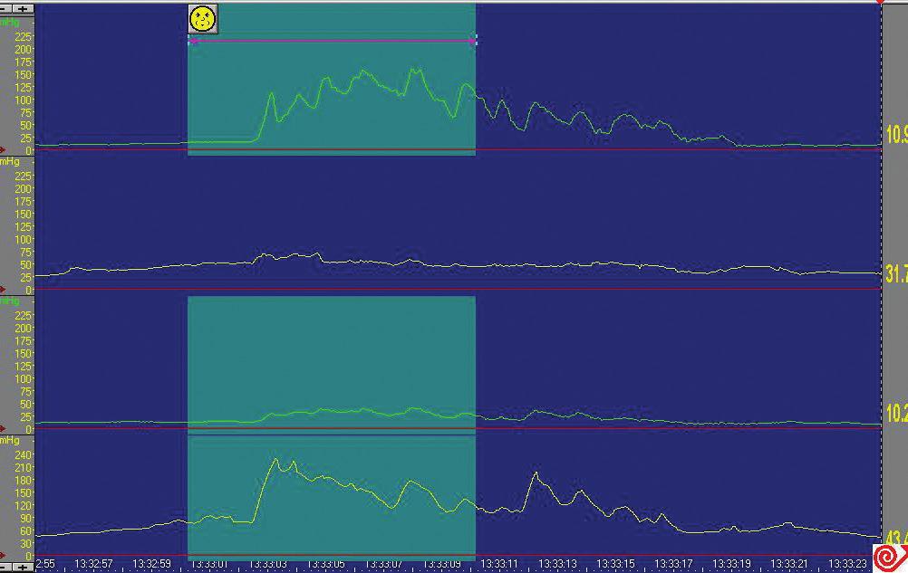 Biofeedback, razem z modyfikacją stylu życia, odpowiednią dietą oraz edukacją pacjenta w zakresie treningu wypróżnień w toalecie, jest uznaną metodą leczenia zaparcia czynnościowego stolca 14,15.