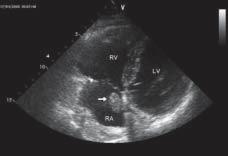 2,0 cm, mogącej odpowiadać skrzeplinie lub guzowi (strzałka); LV lewa komora; RA prawy przedsionek Rycina 2.