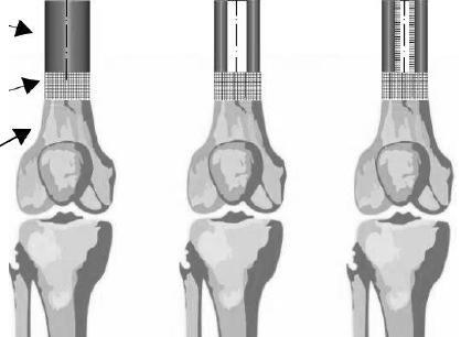 Zitnanskym Lity implant Strefa porowata połączenia dla wrastania żywych komórek Kość