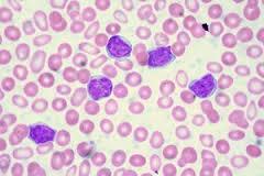 Ostra białaczka limfoblastyczna (Acute Lymphoblastic Leukemia) jest schorzeniem często występującym u chorych przed 30 rokiem życia i stanowi 20% wszystkich ostrych białaczek u ok.