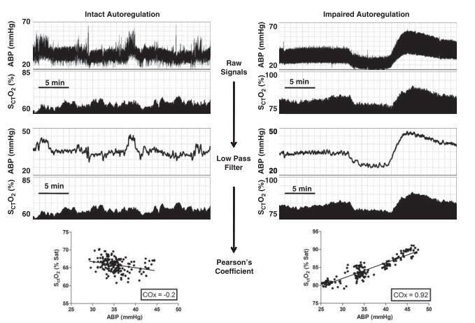 COx Cerebral Oximetry Index *Cox za