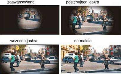 Jaskra pole widzenia. b. Epidemiologia: Światowa Organizacja Zdrowia uznała jaskrę za chorobę cywilizacyjną.