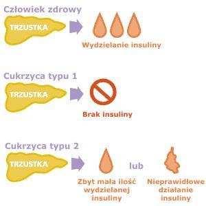 Przyczyną rozwoju powikłań ostrych i przewlekłych w cukrzycy jest utrzymujące się podwyższone stężenie glukozy we krwi.