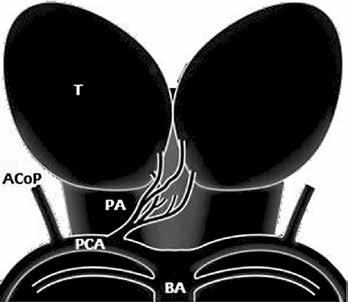 polega na obecności wspólnego pnia tętniczego odchodzącego jednostronnie z segmentu P1 od PCA i zaopatrującej oba wzgórza; typ C most tętniczy łączący oba segmenty P1 od obu PCA (źródło [3]) Rycina 5.