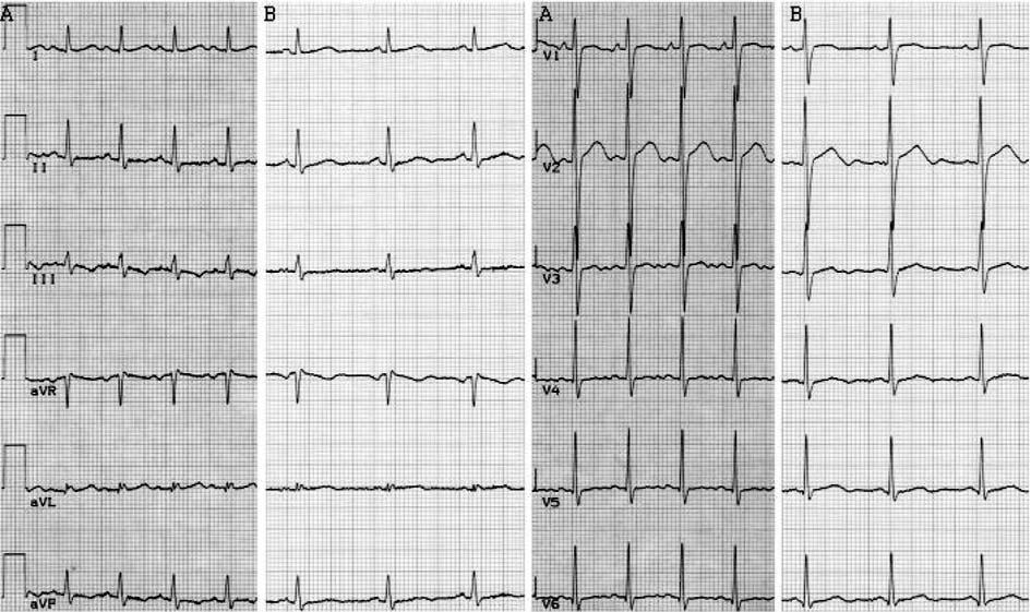 210 Robert Bodalski et al. Rycina 2. Panel A EKG przed ablacją, kilka miesięcy po odstawieniu amiodaronu. AT z częstotliwością ~119/min. Panel B EKG po ablacji. Rytm zatokowy, miarowy 72/min Rycina 3.