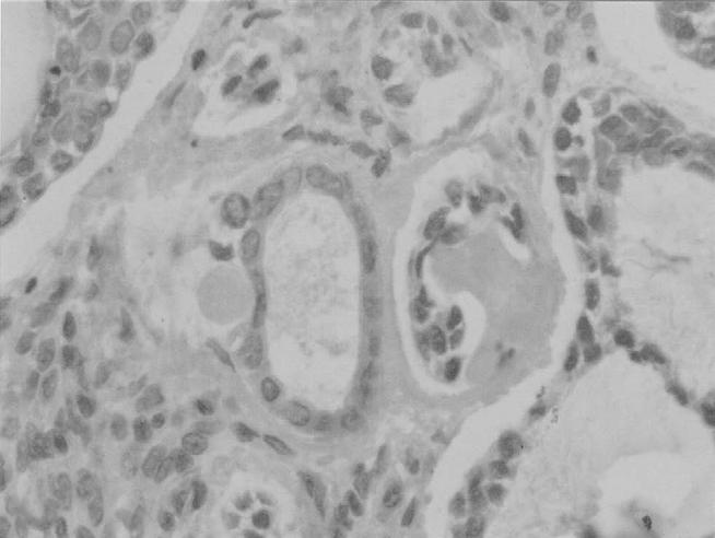 - - - - - Ryc. 1. Reakcja immunohistochemiczna z przeciwciałem przeciw białku p53 w jądrach komórek nowotworowych raka gruczołowato-torbielowatego ślinianek. Powiększenie x.