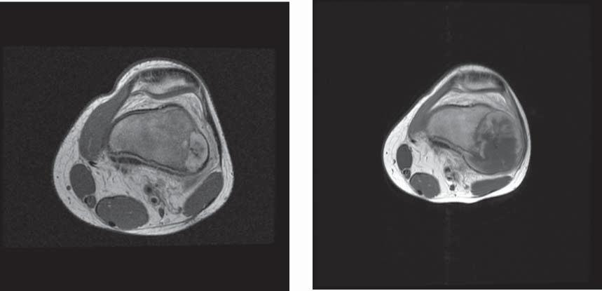 22 In MRI, bone sarcoma displays in T1-dependent imaging in the solid, not mineralized part a low or intermediate signal, in T2-dependent imaging - a heterogeneous, increased signal intensity.