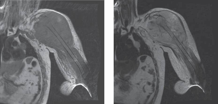 Suitability of imaging methods (X-ray, CT, MRI) in the diagnostics of osteosarcoma in children.