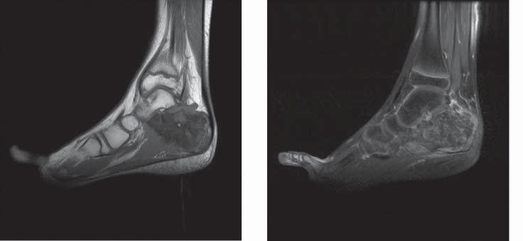 Sequences with fatty tissue saturation: STIR (the lesion displays an increased signal intensity), FAT SAT, supply additional information allowing an exact assessment of the tumor borders, of its